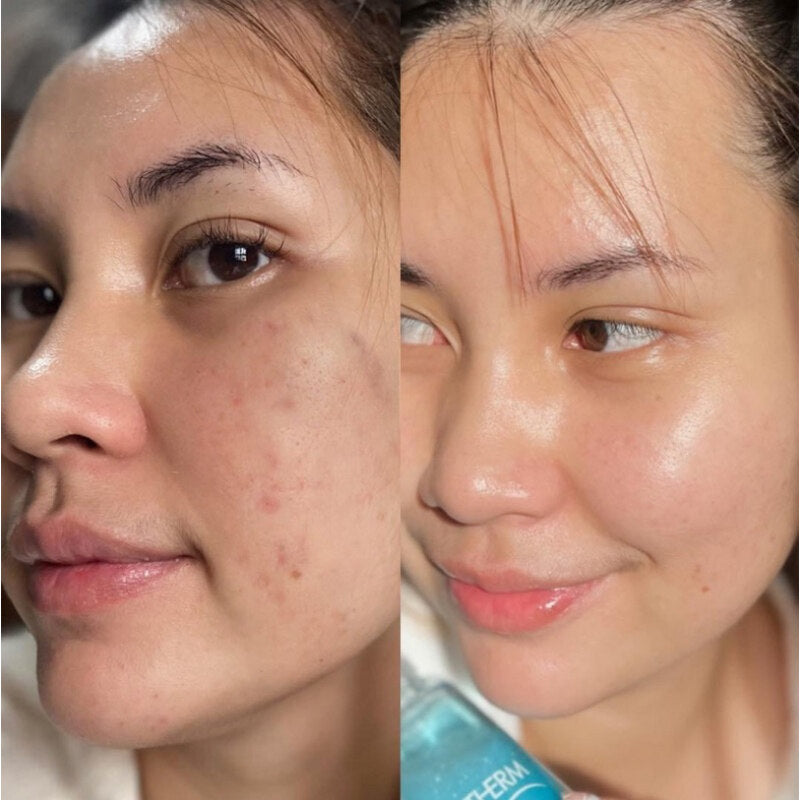 Cerave Acne Control 2% Salicylic Acid Acne Treatment Cleanser 237ml